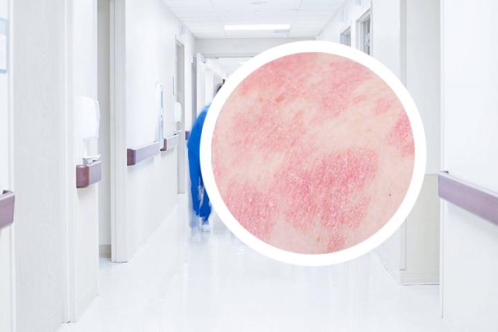 扑尔敏可以治疗银屑病吗
