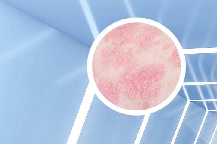 湿清爽银屑病