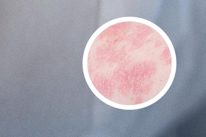 胶原蛋白可以涂抹牛皮癣吗