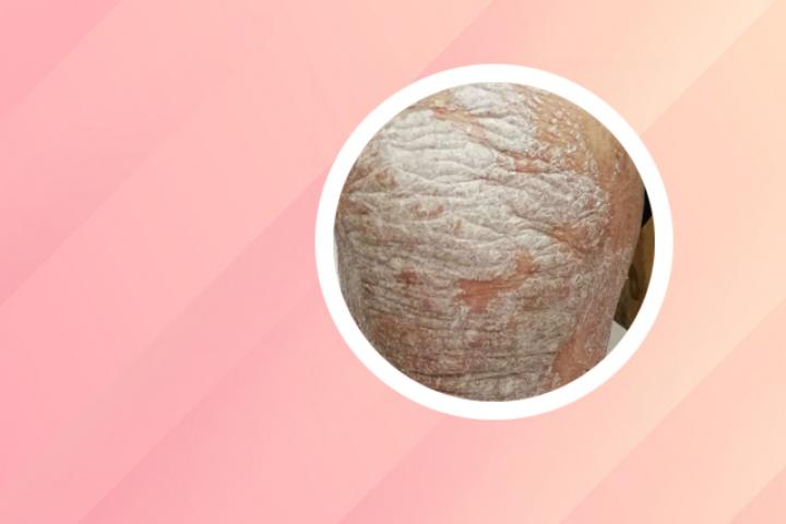 手指甲银屑病药膏