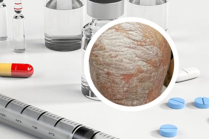 酮康唑乳膏治银屑病行吗