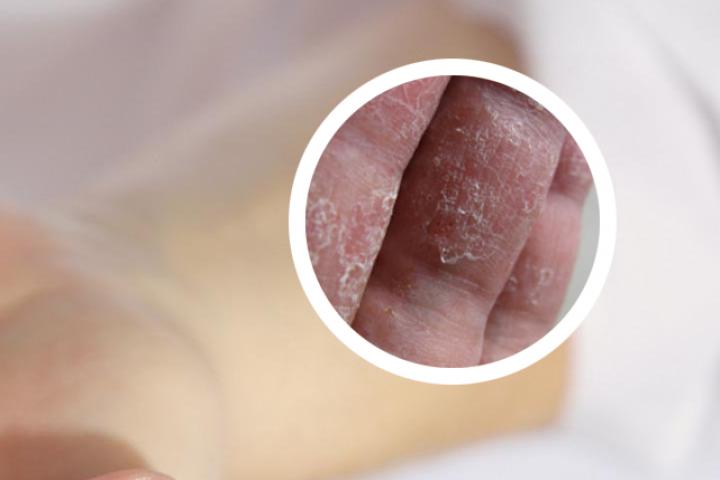 牛皮癣病人喝维生素