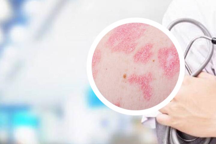 米糠水治疗银屑病