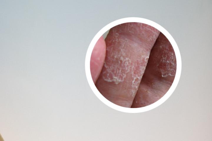 甘草加防风泡水喝能治牛皮癣吗