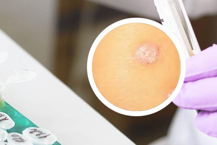邢贵人乳膏可以治牛皮癣吗