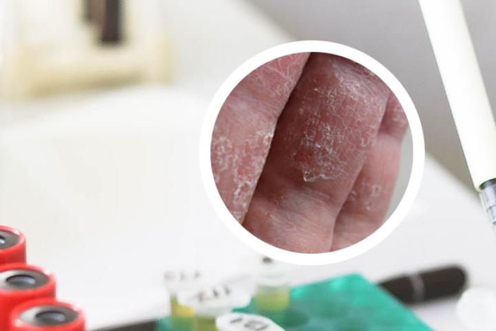 阿维a银屑病疗效