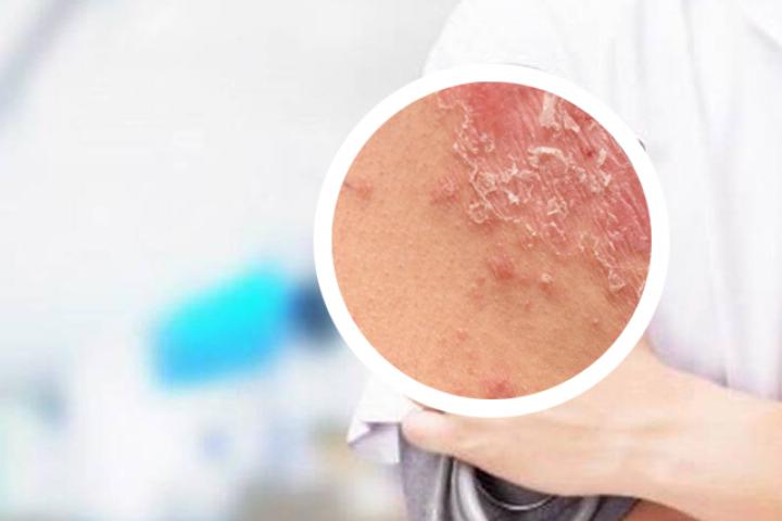 替拉珠单抗治疗银屑病怎么样
