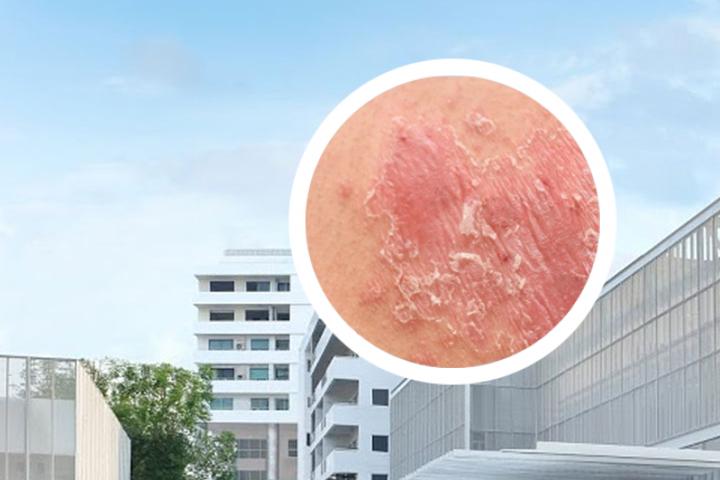 夏季泡澡银屑病加重的原因