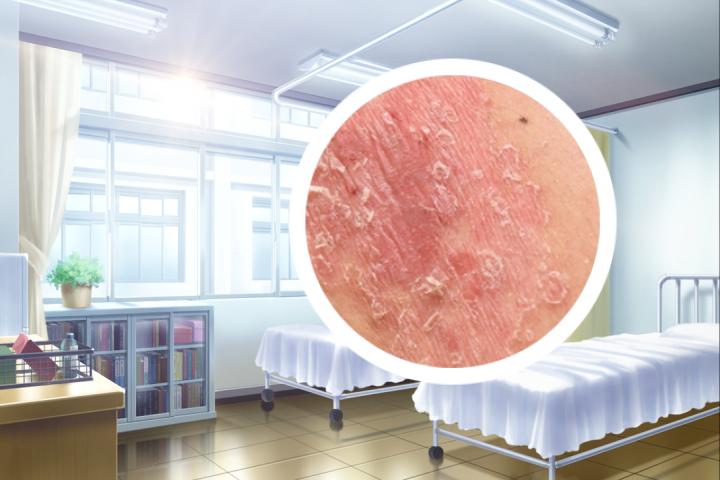 银屑病用牛奶洗澡行吗