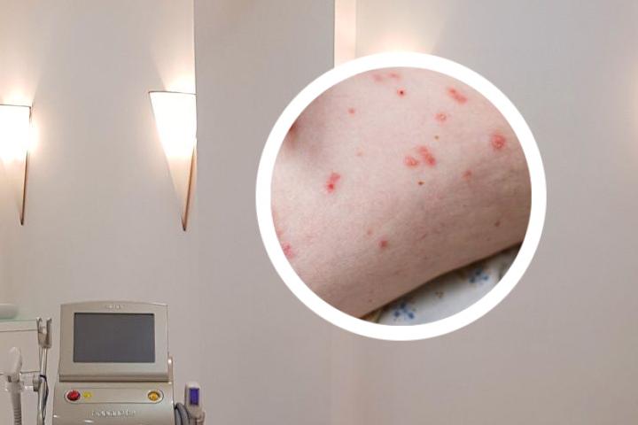 牛皮癣患者交流群
