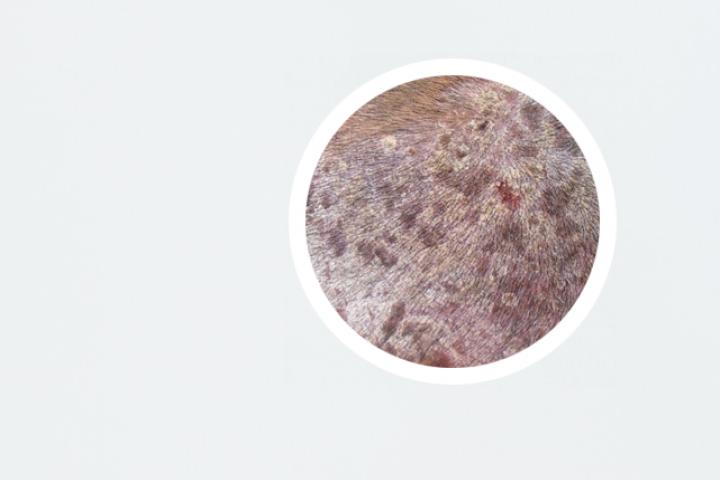 牛皮癣在显微镜下怎么说