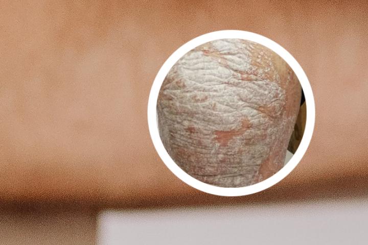 牛皮癣广澳