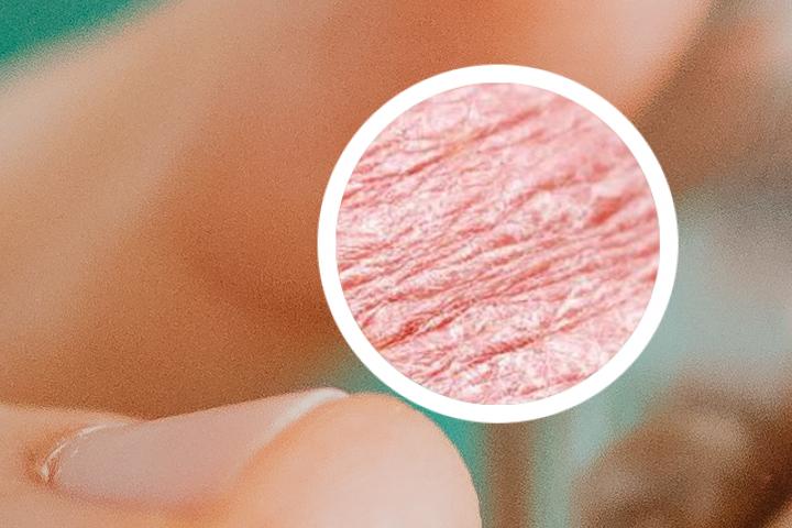 铍相宁治牛皮癣吗