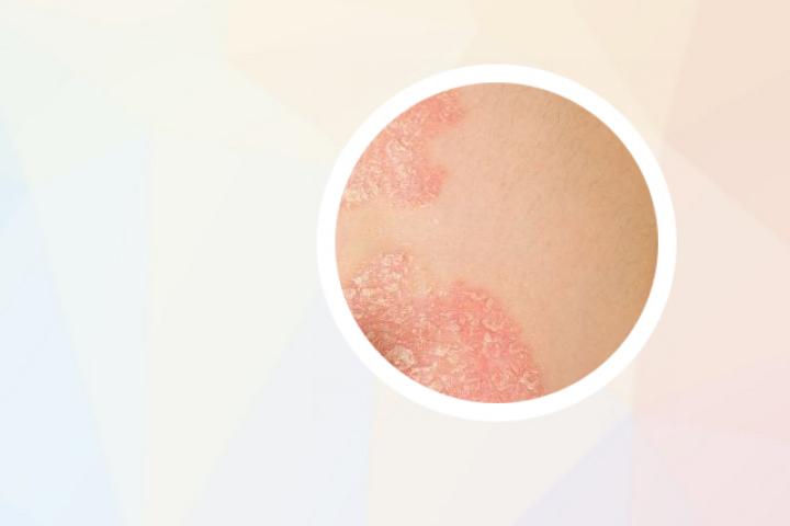 银屑病用蓝光还是红光