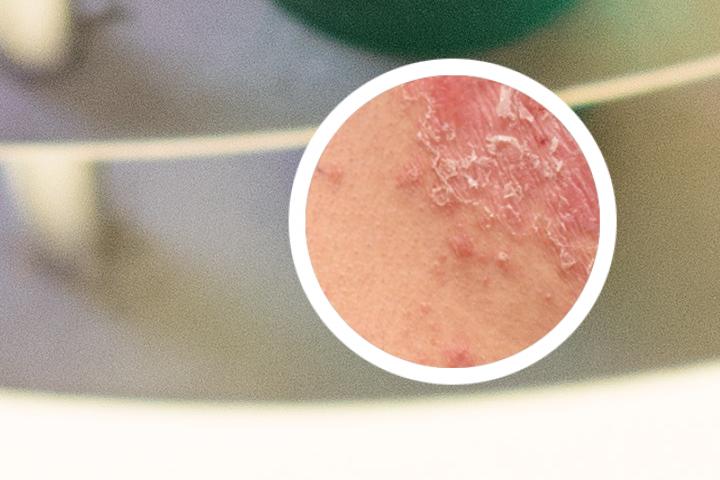 银屑病与湿疹的鉴别诊断