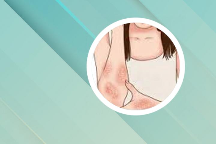 两腿内侧牛皮癣