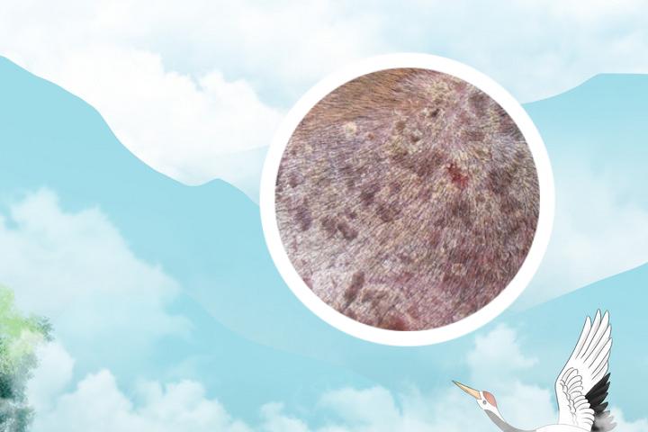 牛皮癣干燥掉皮屑怎么办