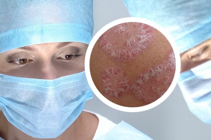 的扁桃体银屑病